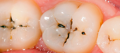 Three Major Plaque Theories for Caries(Cavities)